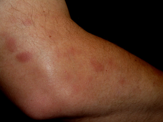 My Bruised Elbow