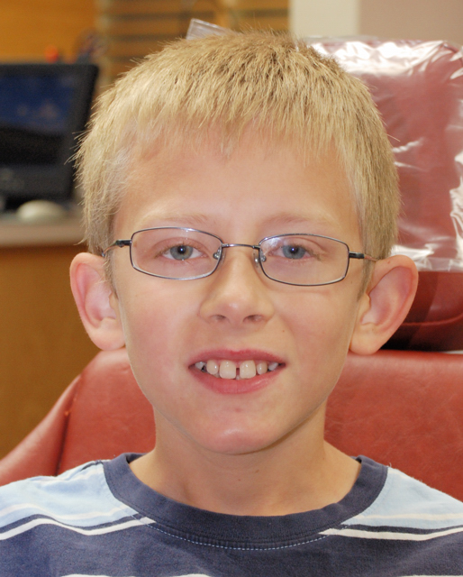 Before Braces